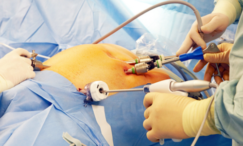Laparoscopic Surgery