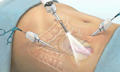 Hernia Repair